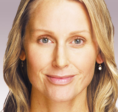 Juvederm Treatment-Wrinkle Treatment-