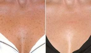 Wrinkle Treatment